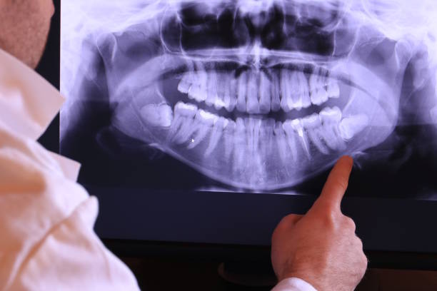 Best Emergency Wisdom Teeth Removal in Newport, WA